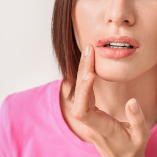 Recurring cold sores consultation