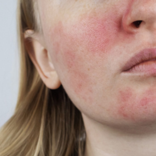Rosacea consultation