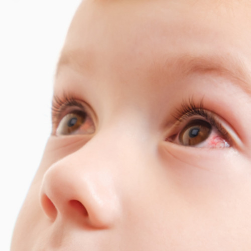 Early Care Service: Conjunctivitis consultation (3 months to 2 years)