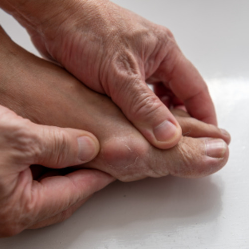Early Care Service: Gout management consultation