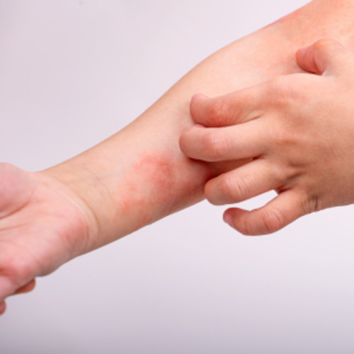 Eczema management consultation