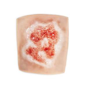 Acid Burn / Chemical Burn