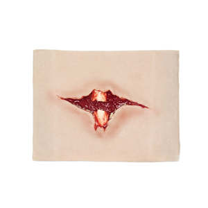 Open Fracture Trauma - Basic Version