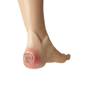 Wrap Around: Bedsore On Heel