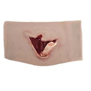 Wrap Around: Broken Humerus Trauma