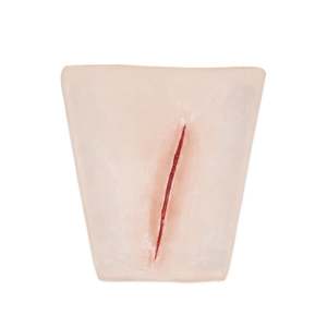 Suture Wrist laceration