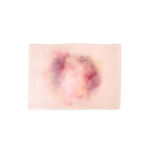 Wrap Around: Femur Fracture Closed