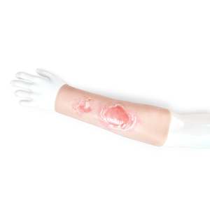 Scalding Burn Sleeve