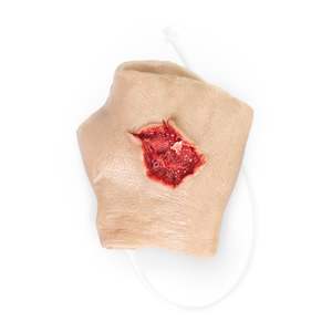 Perforating Right Hand Gun Shot Wound (New)