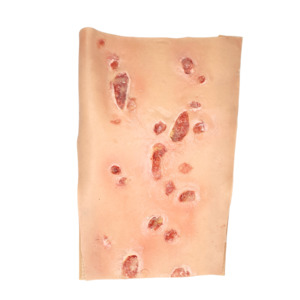 Diabetic Sores On Leg