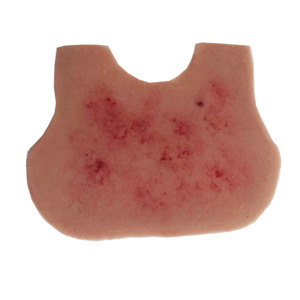 Wearable Overlays: Meningitis Rash Infant Chest