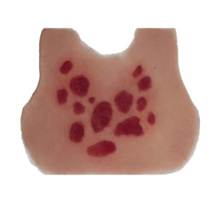 Wearable Overlays: Anaphylactic Rash