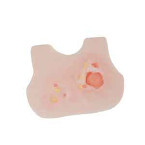 Scalding Burn Infant Chest