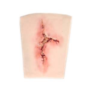 Clinical Simulation: Large Infected Leg Wound