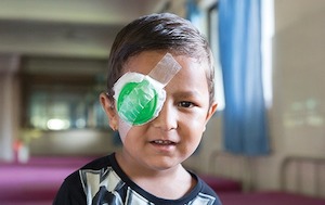 Cataracts – Nepal