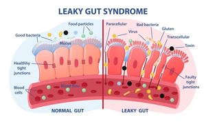 Intestinal Permeability or “leaky gut”