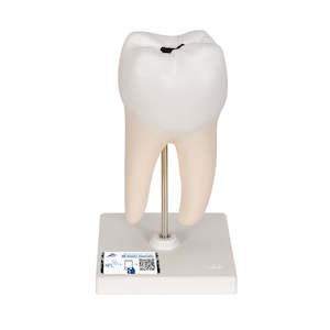 Anatomy: Lower Twin-Root Molar with Cavities Human Tooth Model, 2 Part