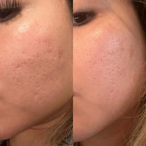 Treatment Promotions 1: Microneedling Treatment Full Face