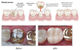 Crowns