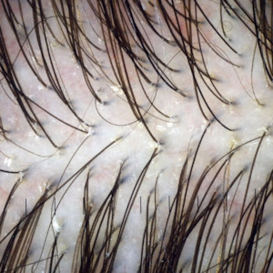 Scalp Concerns: Trichology Consultation