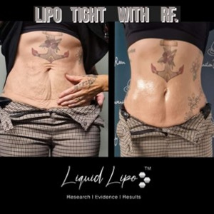 Liquid Lipo Tight 5 day at-home kit Mystic Beauty