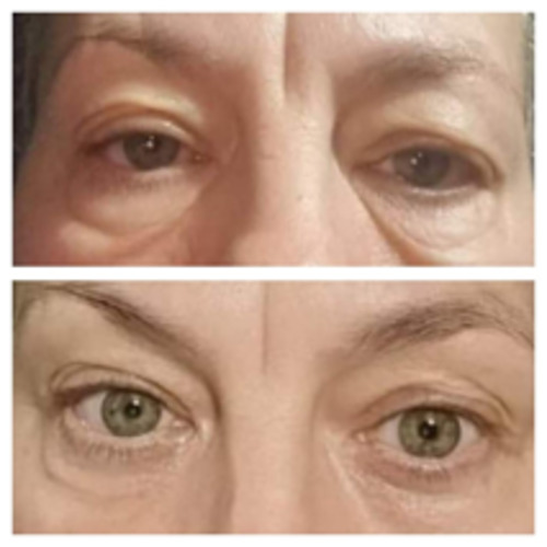 Products: Blepharonat Peri Orbital Removal Mystic Beauty