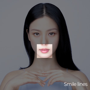 Ultraformer MPT Skin Lifting and Tightening Smile Lines Treatment Korea Beauty Clinic