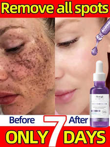 Dark Spots Remover Whitening Serum Face Freckle Melanin Correcting Anti Pigmenta&hellip;