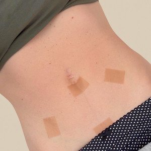 Products: Myscar Body silicone strips - mini 5cm - 4 month supply Myscar