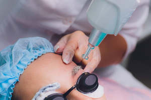 Brands: Cosmetic Brow Tattoo Removal - 3 Treatments