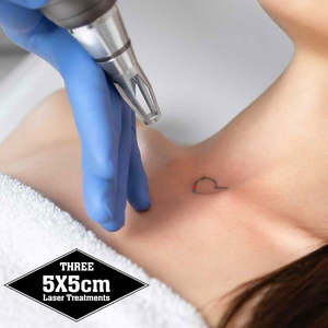 Three Treatments - up to 5cm x 5cm Laser Tattoo Removal - Save $30