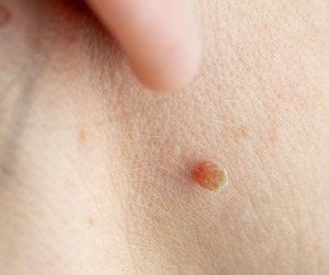 TagZapper - Skin Tag Support - July Product of the Month