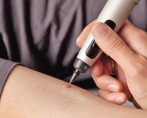 Cryotherapy (CryoPen)