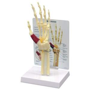 Anatomical Models: MODEL HAND/WRIST - CARPAL TUNNEL SYNDROME