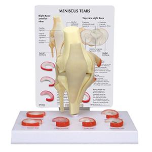 MODEL MENISCUS TEARS OF THE KNEE