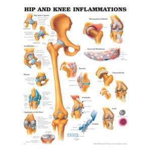 Charts: CHART HIP AND KNEE INFLAMMATION