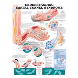 STOCK ITEM-DEFAULT-UNCLASSIFIED: CHART UNDERSTANDING CARPAL TUNNEL SYNDROME